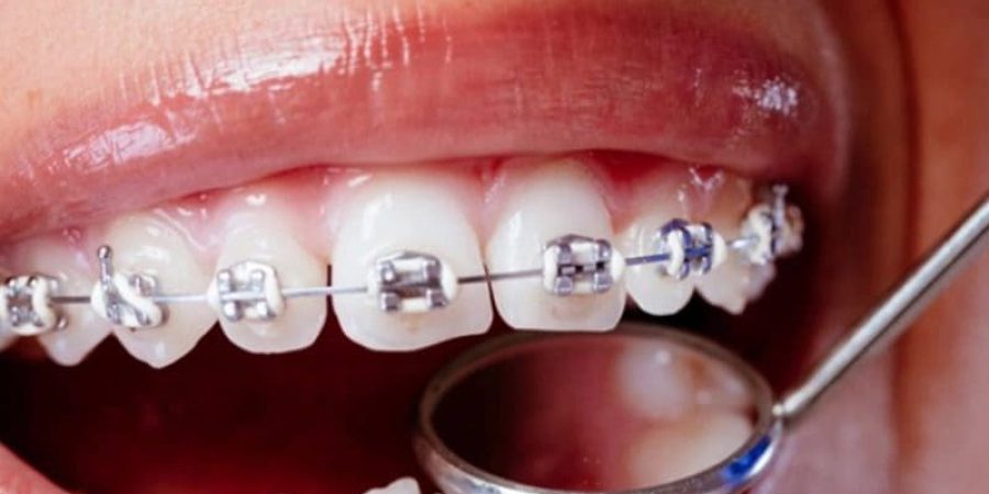 تقويم الأسنان ومعلومات مهمة عليك معرفتها.