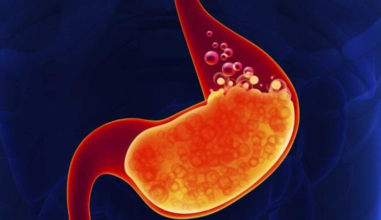 حموضة المعدة