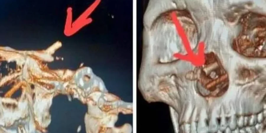 صورة الأشعة للجمجمة