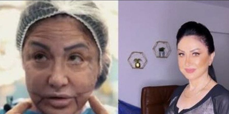 تشوه وجه الفنانة السورية وفاء سالم بعد خضوعها لعملية تجميل- تويتر