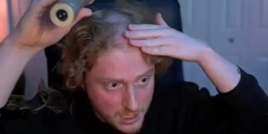 الشاب تفاجئ بجود تجويف في جمجمته بسبب سماعات الرأس وذلك بعد مشاركته في حلق شعره لعمل خيري في بث مباشر