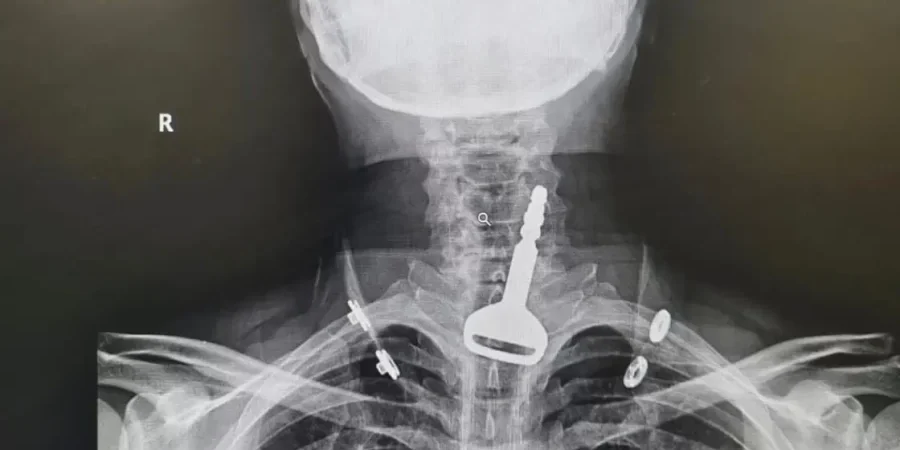 اشعة تبين وجود المفتاح في حلق الشخص