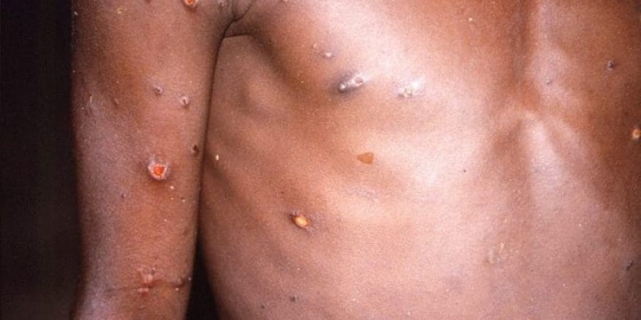 طفرات جلدية على جسم شاب مصاب بجدري القرود (أرشيفية)