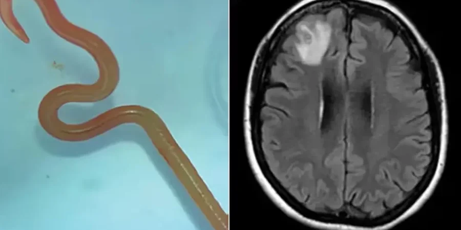 الدودة في دماغ المريضة