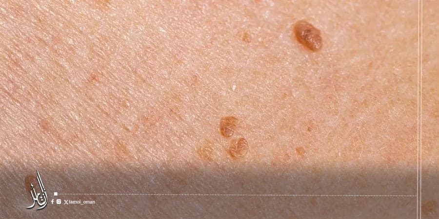 فيروس الورم الحليمي البشري (HPV)